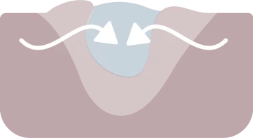 Wound Healing